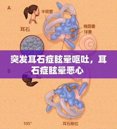 突發(fā)耳石癥眩暈嘔吐，耳石癥眩暈惡心 